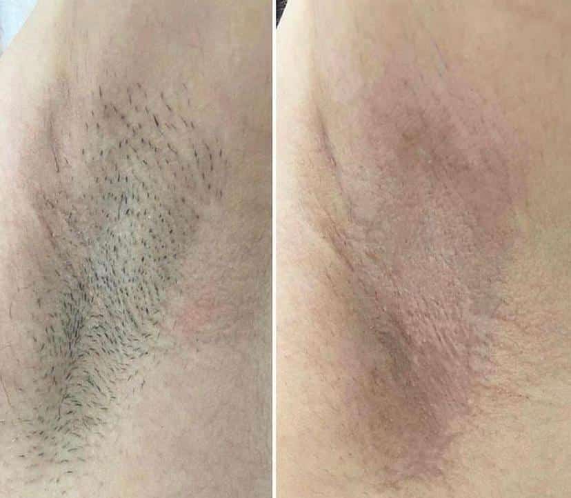 Koltuk altı epilasyon öncesi ve sonrası